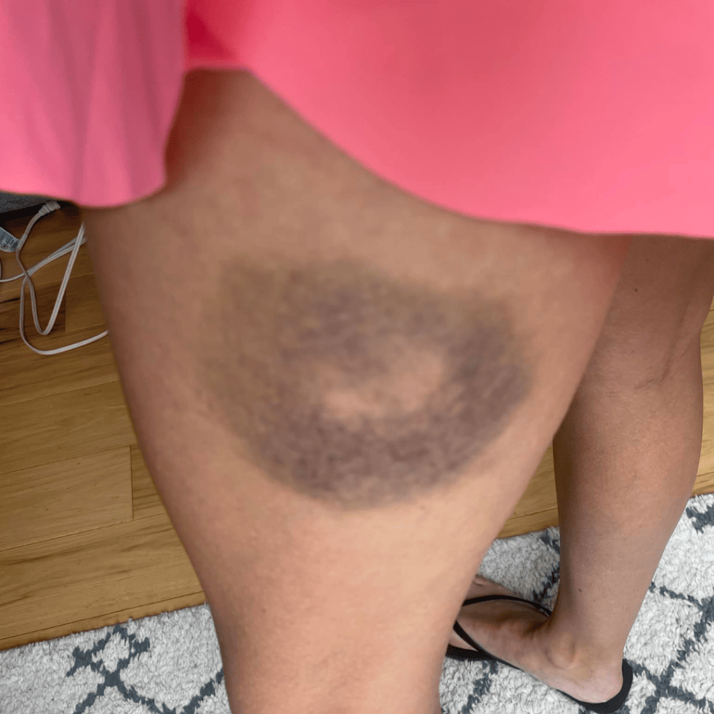 Image accompanying Post Seven: Ouch! Glad nothing worse happened! Be careful out there!☀️⛳️